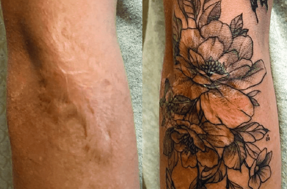 Une blessure qui guérit l’autre : tatouages ​​pour cicatrices